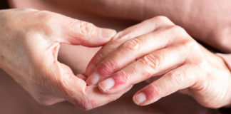 Pszoriázis kezelés: minden ami hatékony módszer bőrbetegség enyhítésére pszoriazis_kezeles_viszeketo_kezen