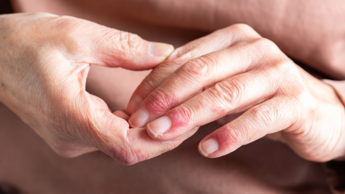 pszoriazis_kezeles_viszeketo_kezen